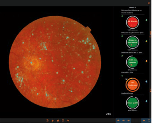 Viewer Ia Ophtalmologie